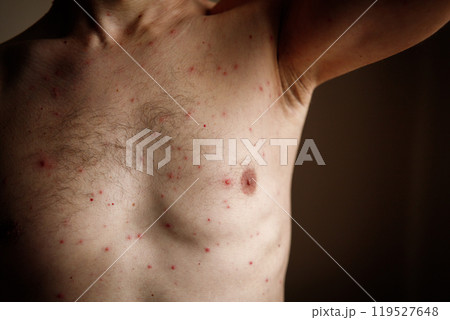 Red rash man's chest with varicella blisters, also known as chickenpox or monkeypox. Red rash man's chest with varicella blisters, also known as chickenpox or monkeypox. 119527648