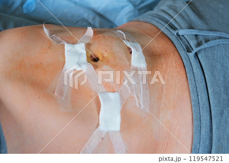 Hands of medic or nurse in blue gloves examining a fresh suture on a male stomach after laparoscopy surgical removal of appendicitis. Doctor examines of the patient. Man belly with medical stitches Hands of medic or nurse in blue gloves examining a fresh suture on a male stomach after laparoscopy surgical removal of appendicitis. Doctor examines of the patient. Man belly with medical stitches 119547521