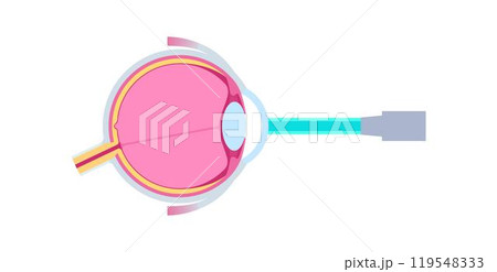 Lasik eye surgery 119548333