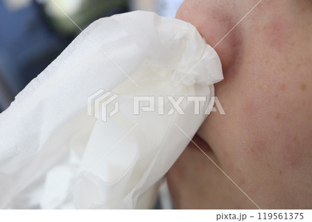 ティッシュペーパーを鼻に詰めている女性 ティッシュペーパーを鼻に詰めている女性 119561375