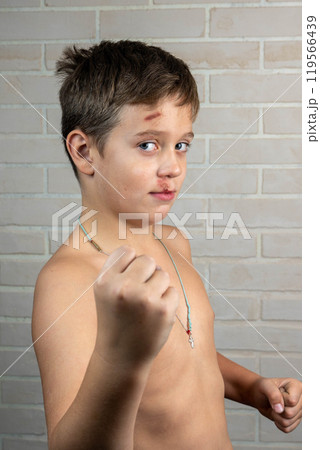 Boy with a black eye and a bruise on his forehead Boy with a black eye and a bruise on his forehead 119566439