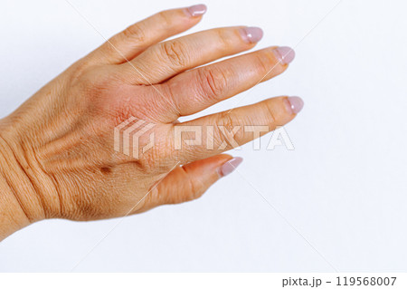 female hand with pigment spots on skin, swollen finger from insect bite female hand with pigment spots on skin, swollen finger from insect bite 119568007