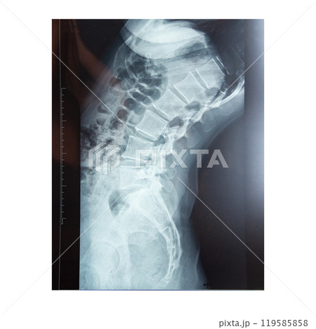 Medical x-ray of the spine body isolated on the white background Medical x-ray of the spine body isolated on the white background 119585858