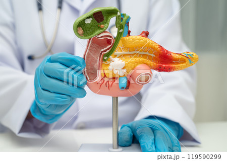 Pancreatitis, pancreatic cancer, Asian doctor with pancreas, gallbladder and bile duct human anatomy model at hospital. 119590299