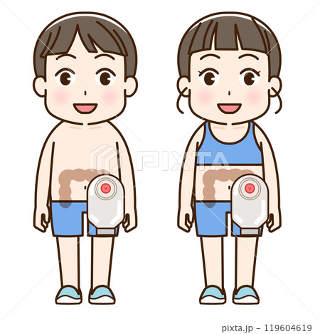 人工肛門、ストーマ、大腸、子供、こども、イラスト、illustration 119604619