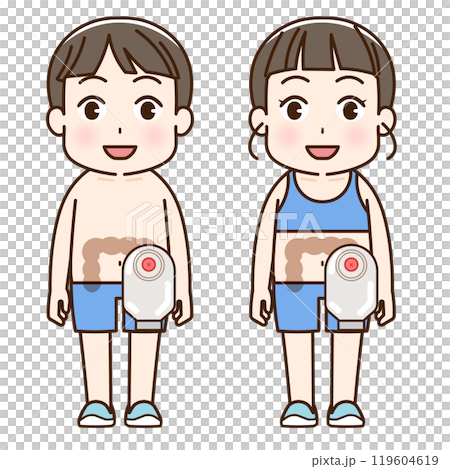 人工肛門、ストーマ、大腸、子供、こども、イラスト、illustration 119604619