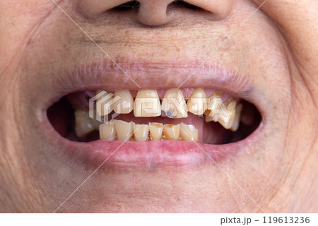 Attrition tooth due to interaction with other teeth in elderly woman. 119613236