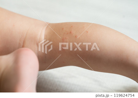 手足口病にかかった一歳の男の子	 119624754