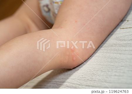 手足口病にかかった一歳の男の子	 119624763