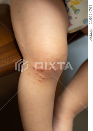 手足口病にかかった一歳の男の子 手足口病にかかった一歳の男の子 119624765