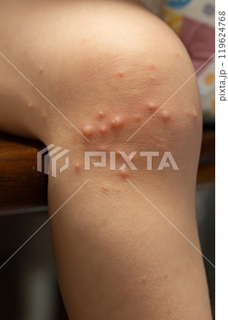 手足口病にかかった一歳の男の子	 119624768