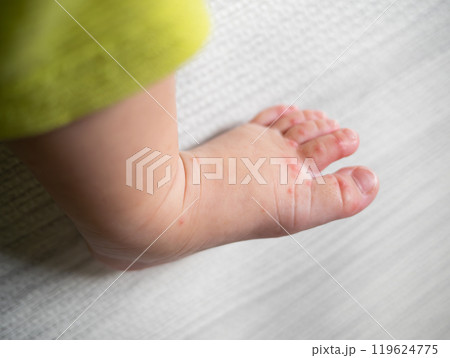 手足口病にかかった一歳の男の子 手足口病にかかった一歳の男の子 119624775