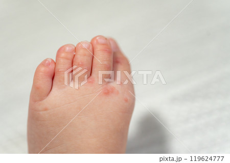 手足口病にかかった一歳の男の子 手足口病にかかった一歳の男の子 119624777
