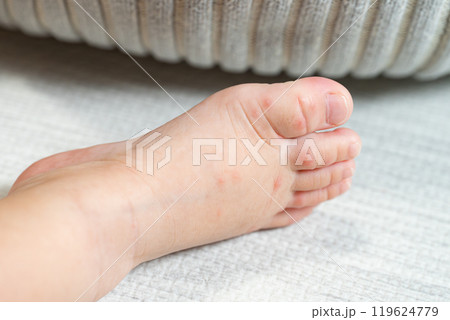 手足口病にかかった一歳の男の子 手足口病にかかった一歳の男の子 119624779