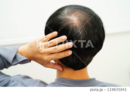 Bald head in man, hair loss treatment health problem. 119635841