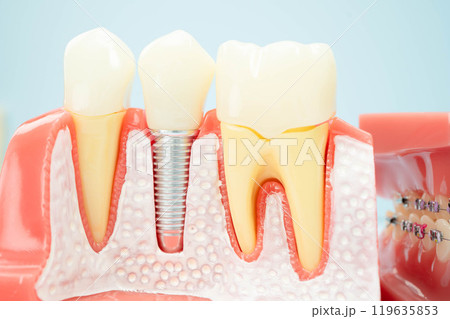 Dental implant, artificial tooth roots into jaw, root canal of dental treatment, gum disease, teeth model for dentist studying about dentistry. Dental implant, artificial tooth roots into jaw, root canal of dental treatment, gum disease, teeth model for dentist studying about dentistry. 119635853