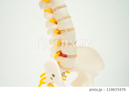 Spinal nerve and bone, Lumbar spine displaced herniated disc fragment, Model for treatment medical in the orthopedic department. 119635876
