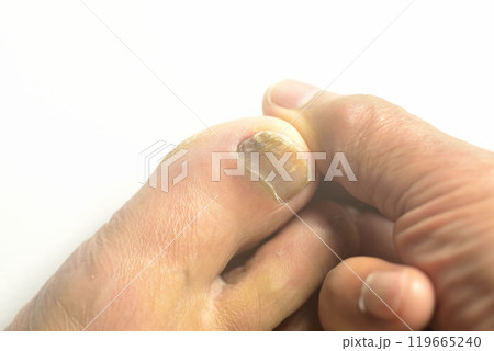 足爪水虫のクローズアップ 119665240