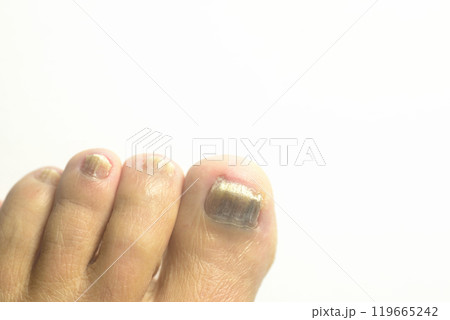 足爪水虫のクローズアップ 119665242
