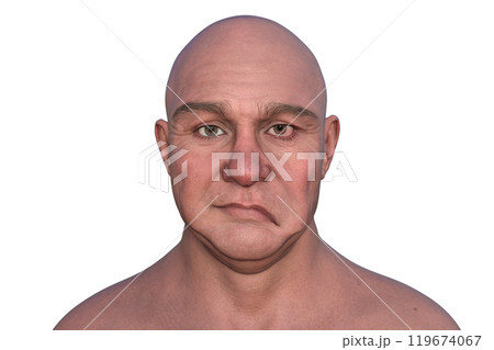 Facial palsy in a man, photorealistic 3D illustration 119674067