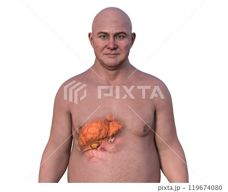 Fatty liver in a man, 3D illustration 119674080