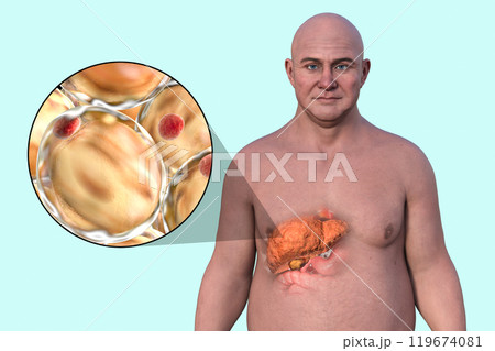 Fatty liver in a man, 3D illustration 119674081