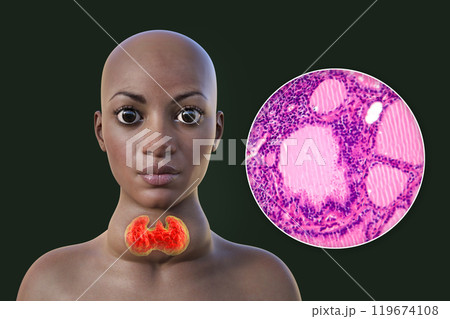 An African woman with enlarged thyroid with exophthalmos, 3D illustration An African woman with enlarged thyroid with exophthalmos, 3D illustration 119674108