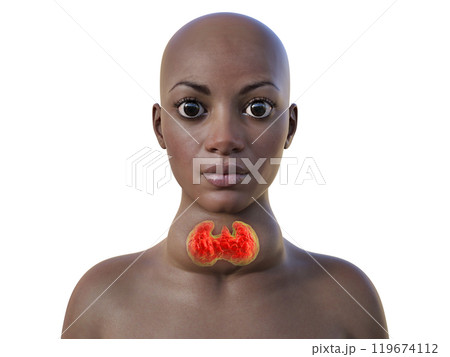An African woman with enlarged thyroid and exophthalmos, 3D illustration 119674112