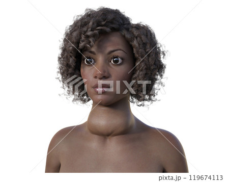 An African woman with enlarged thyroid and exophthalmos, 3D illustration An African woman with enlarged thyroid and exophthalmos, 3D illustration 119674113