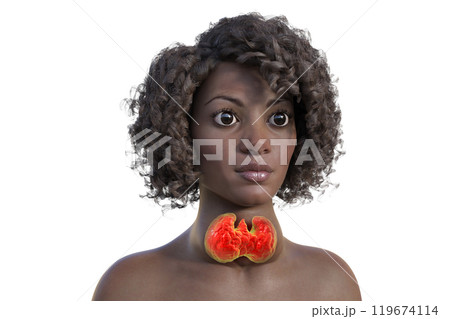An African woman with enlarged thyroid and exophthalmos, 3D illustration 119674114