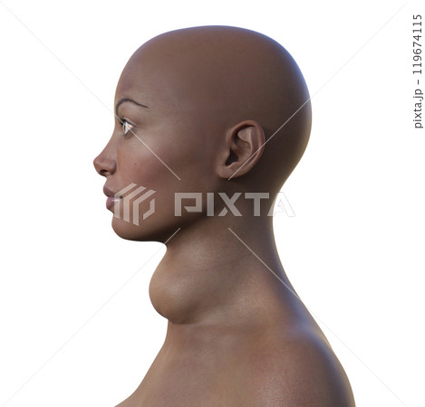 An African woman with enlarged thyroid and exophthalmos, 3D illustration 119674115