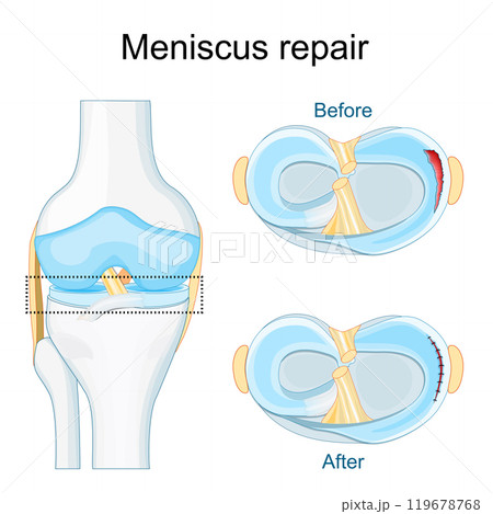Meniscus injury. Close-up of knee joint. Meniscus injury. Close-up of knee joint. 119678768