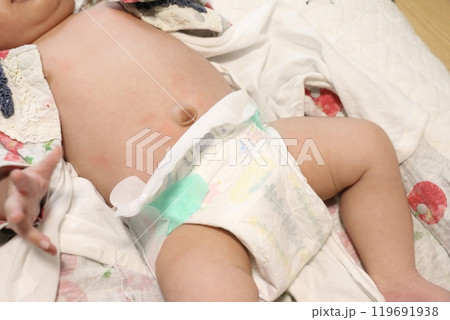 赤ちゃんのおへその画像　でべそ　さいヘルニア 119691938