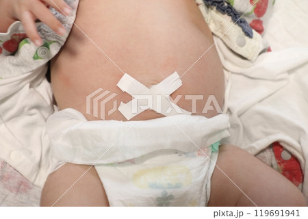 赤ちゃんのおへその画像　でべそ　さいヘルニア 119691941