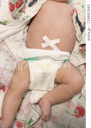 赤ちゃんのおへその画像　でべそ　さいヘルニア 119691943
