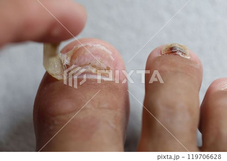 はがれた足の親指の爪 はがれた足の親指の爪 119706628