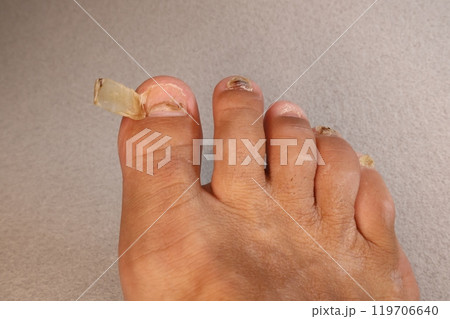 親指の爪 はがれた足の親指の爪の写真素材 [119706640] - PIXTA