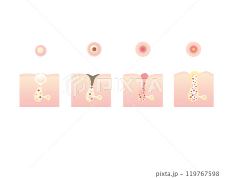 ニキビのイラスト 119767598