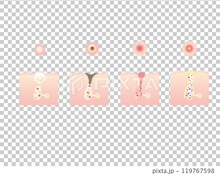 ニキビのイラスト 119767598