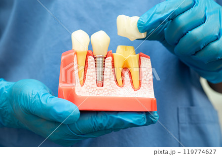 Dental implant, artificial tooth roots into jaw, root canal of dental treatment, gum disease, teeth model for dentist studying about dentistry. Dental implant, artificial tooth roots into jaw, root canal of dental treatment, gum disease, teeth model for dentist studying about dentistry. 119774627