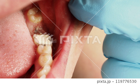 Close up on suture after gum surgery. The molar was extracted and the wound was closed with stitches and adjacent tooth was filled with temporary filling material for root canal treatment. Dental care Close up on suture after gum surgery. The molar was extracted and the wound was closed with stitches and adjacent tooth was filled with temporary filling material for root canal treatment. Dental care 119776530