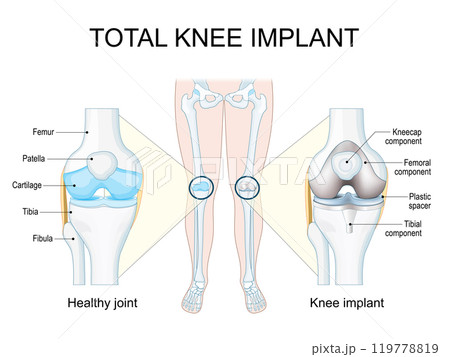 Total knee implant 119778819