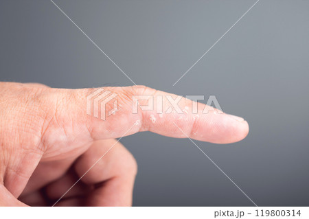 Peeling skin on a fingertip, focusing on a close-up of a peeling index finger. The image highlights the concept of skin health, emphasizing issues like dryness, irritation, or environmental damage 119800314