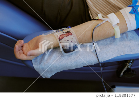 Patient donating blood sitting on hospital chair with blood bag attached to arm. Arm supported by protective padding and health monitoring devices connected 119801577