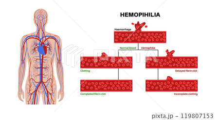 Hemophilia medical poster 119807153