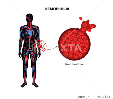 Hemophilia medical poster 119807154