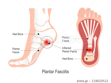 Plantar fasciitis is pain on the bottom of foot. 119810522