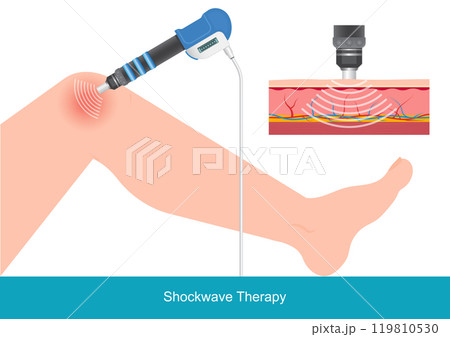Treating overexerted leg muscles with Extracorporeal Shock Wave. 119810530