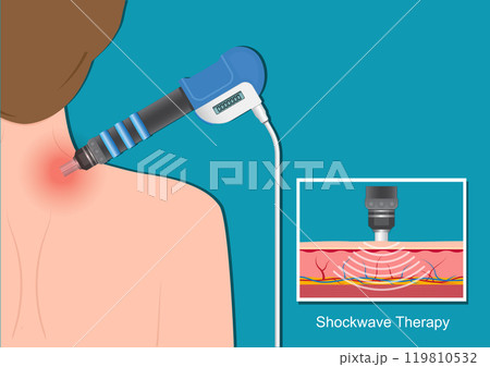 Extracorporeal Shock Wave Therapy. 119810532