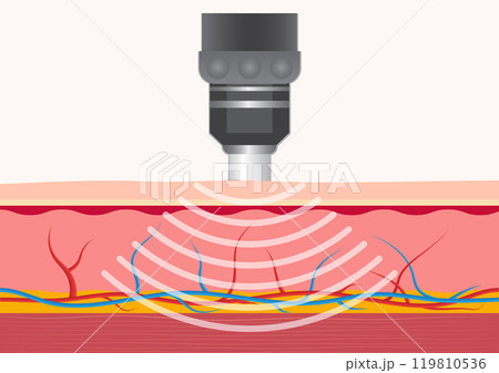 Extracorporeal shockwave therapy (ESWT) treats. 119810536